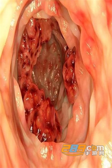Colorectal cancer大肠癌app(病理知识)v1.0安卓版