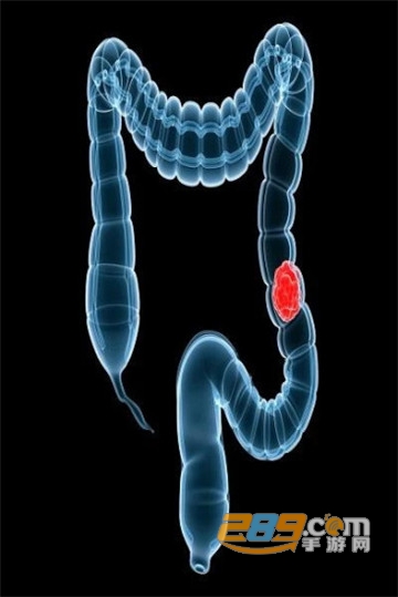 Colorectal cancer大肠癌app(病理知识)v1.0安卓版